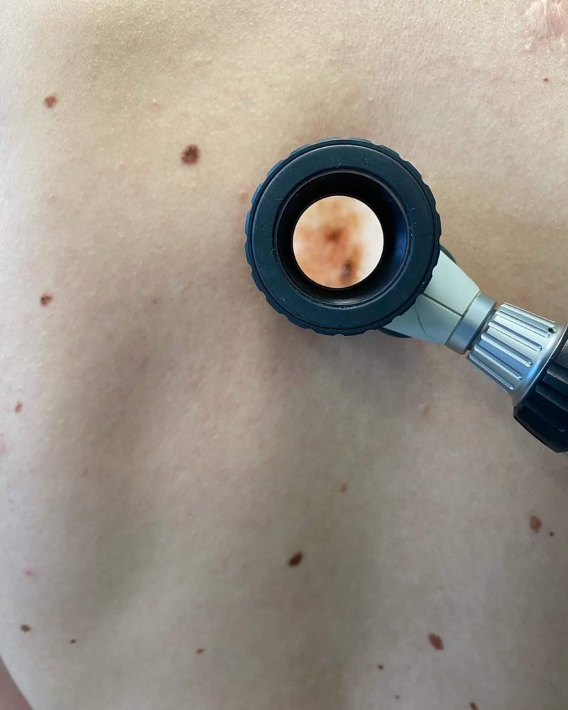 Wideodermatoskopia – Fotofinder: diagnostyka czerniaka, dosgnostyka raka skóry