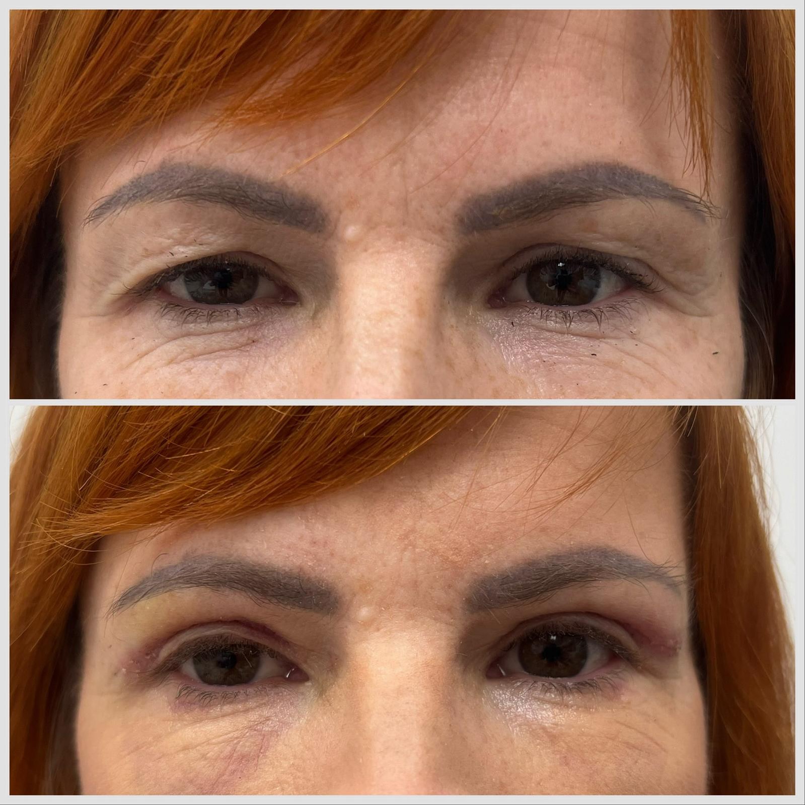 Blefaroplastyka, plastyka powiek, opadanie powiek