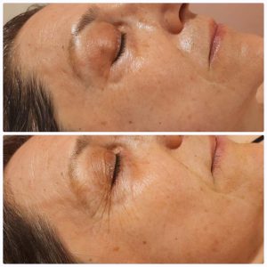 Peeling medyczny naturalny Gdańsk
