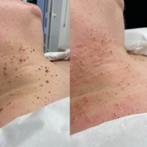 Laser frakcyjny CO2 Gdańsk