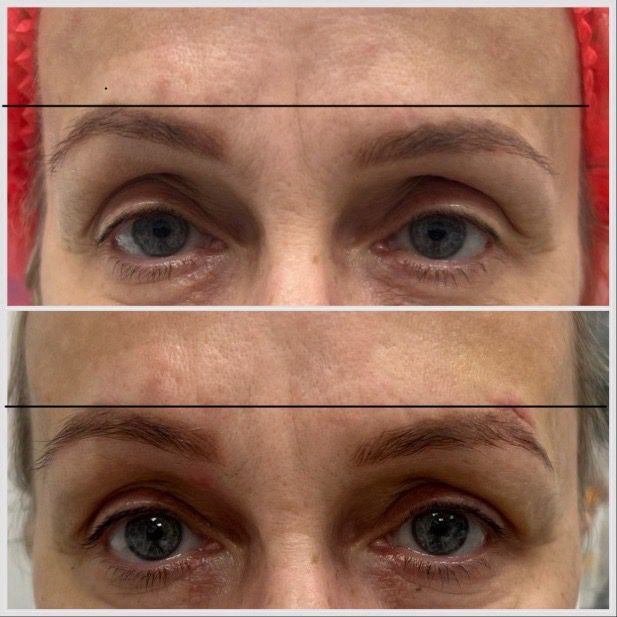 Podniesienie brwi – brow lift