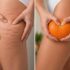 ☀️ Wakacyjna promocja na Endermologię LPG Infinity!